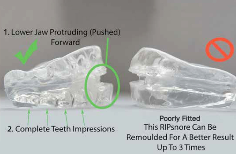 RIPsnore 2 x Anti Snoring Mandibular Advancement Splint Device